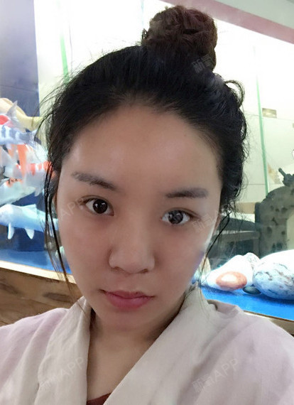 是不是做完之后之前的双下巴还有脸上的肉肉明显没有了呀,虽然还有点