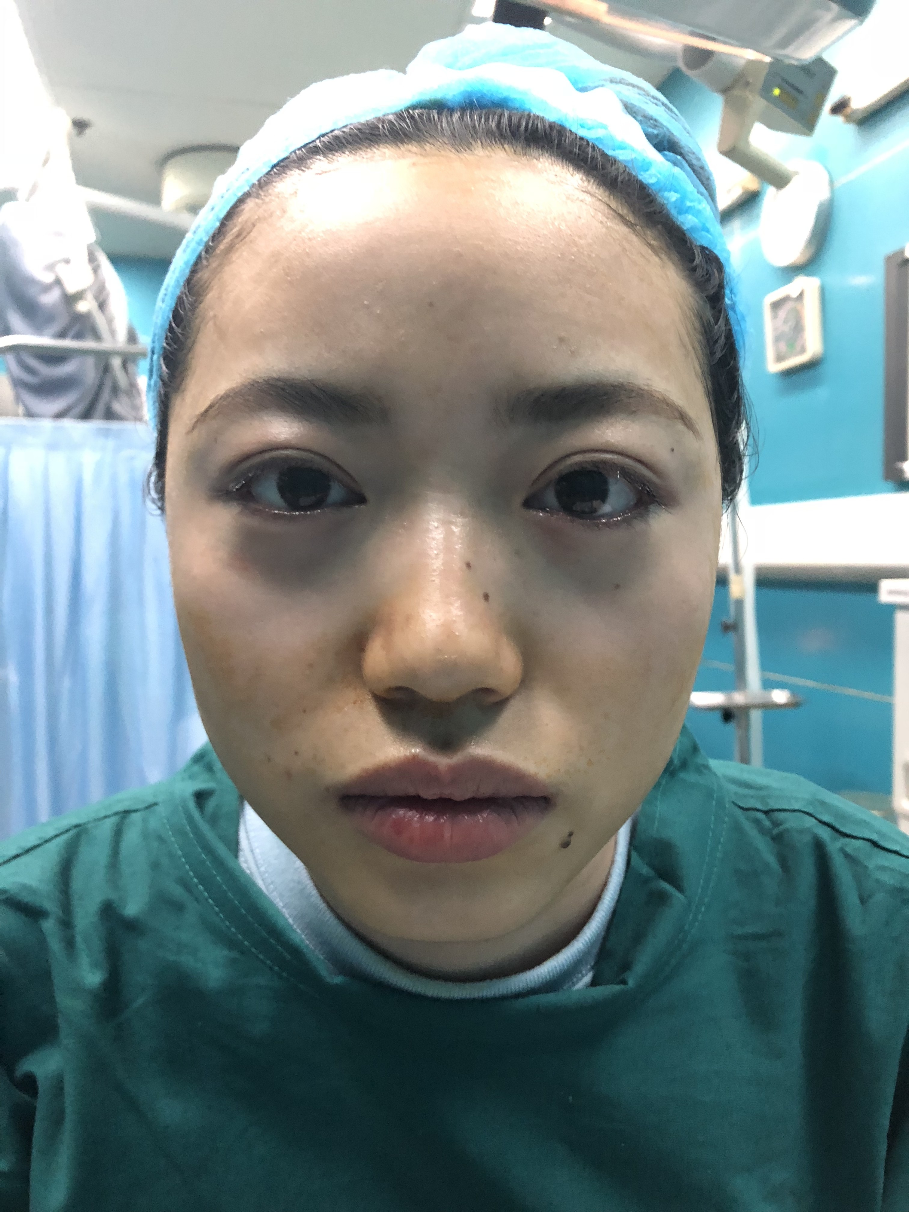 内切去眼袋好不好_效果图_氧气usc34f0内切去眼袋术后第0天_新氧美容