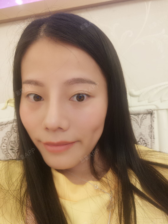 单侧埋线酒窝术后5天,恢复的还挺好的,哈哈~只做了_圈子-新氧美容整形