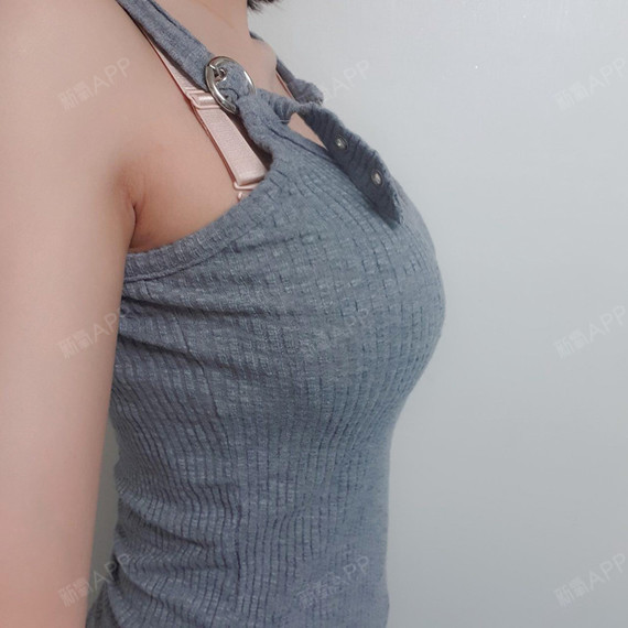 小司音假体隆胸第97天美丽日记-新氧美容整形