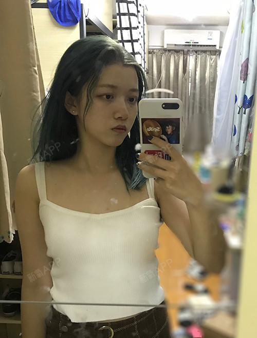 重庆假体隆胸好不好_效果图_氧气y3rxz假体隆胸术后第14天_新氧美容