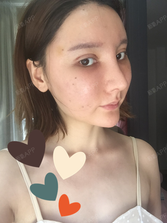 等消肿了就好了 现在山根高度,鼻子弧度我都很满意 照片奉上 做最