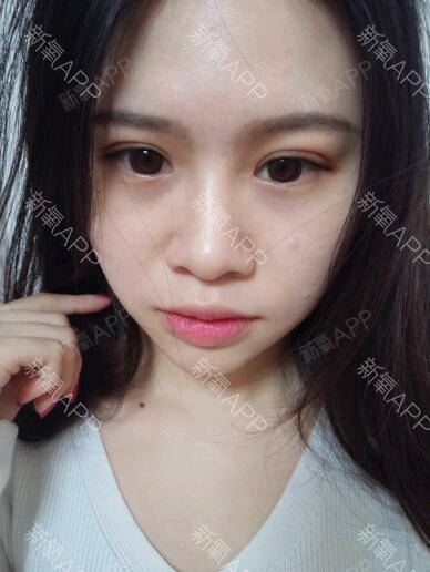 上海定点双眼皮好不好_效果图_jyje定点双眼皮术后第7天_新氧美容整形