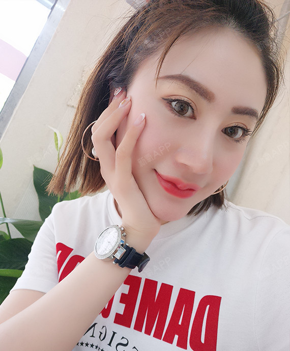 假体下巴 术后第30天