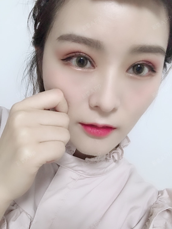 双眼皮一个月了,恢复的是越来越自然了越来越好看了,_圈子-新氧美容