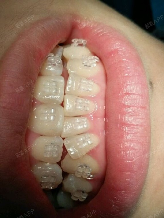 我的牙齿是门牙向外凸,下门牙有两颗歪的,嘴的侧面突_圈子-新氧美容