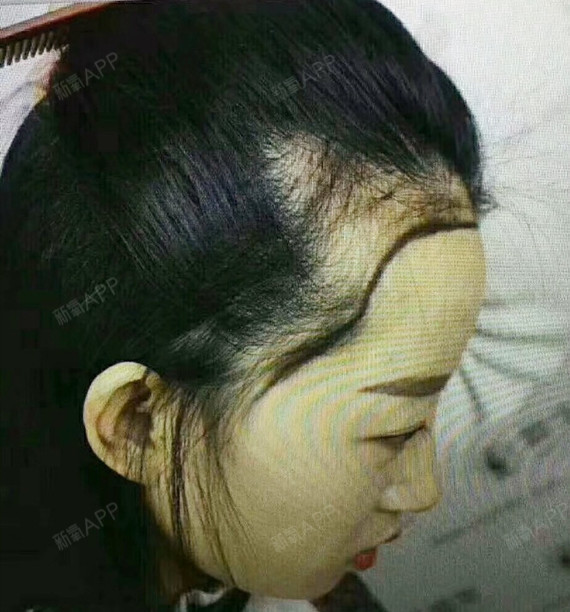 半永久纹发际线好不好_效果图_氧气gsz86a7半永久纹发际线术后第0天