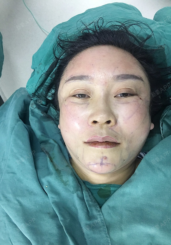 已经有了立体的轮廓,松弛下垂的皮肤也提上去了,关键是口角都觉得网