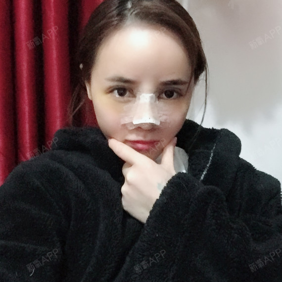 术前鼻头太高挺,太大,山跟低,每次看着鼻头这么大