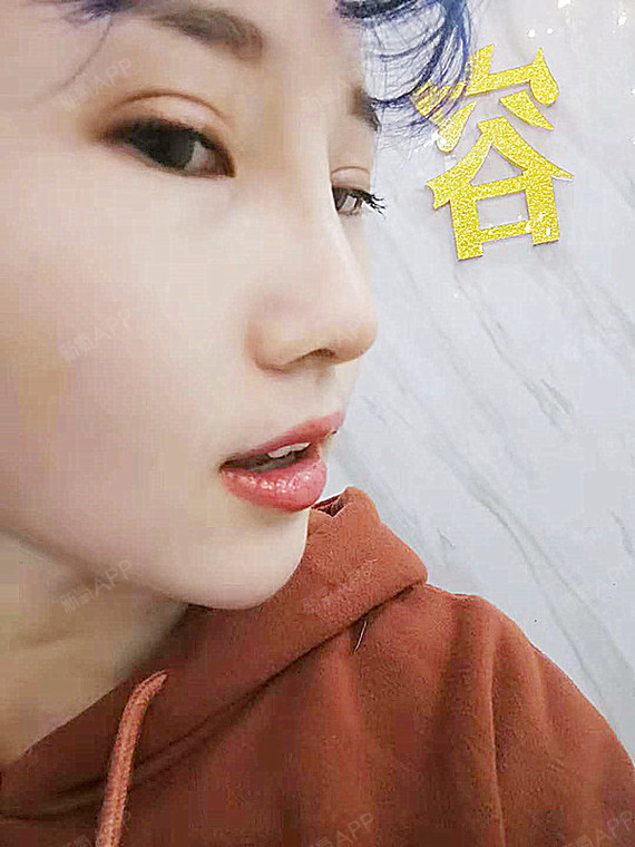 合肥光美整形医院硅胶隆鼻术后第15天