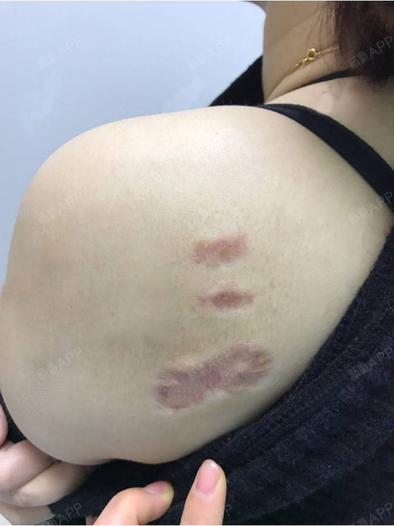 氧气jtzd207无创疤痕修复术后第28天美丽日记_新氧整形