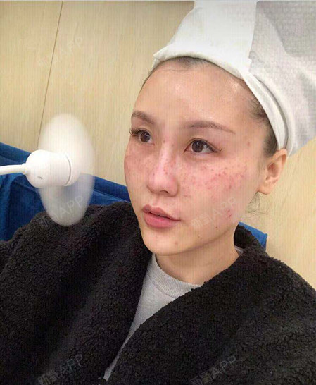 【南京容易医疗整形美容】之前在美容院做过激光祛斑,_圈子-新氧美容