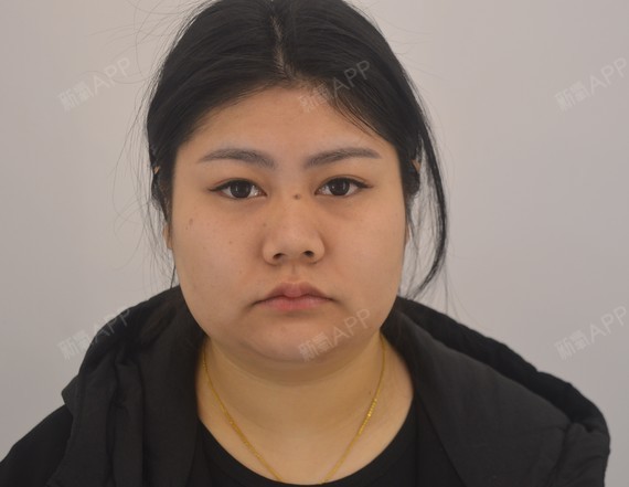 面部吸脂好不好_效果图_氧气8ok929f面部吸脂术后第1天_新氧美容整形