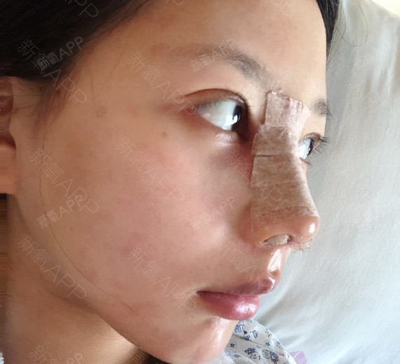 一觉醒来觉得自己快散架了,第一次做全麻的手术,还是_圈子-新氧美容