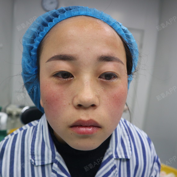 西安眶隔脂肪释放好不好_效果图_暖阳3眶隔脂肪释放术后第1天_新氧