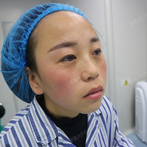 西安眶隔脂肪释放好不好_效果图_暖阳3眶隔脂肪释放术后第1天_新氧