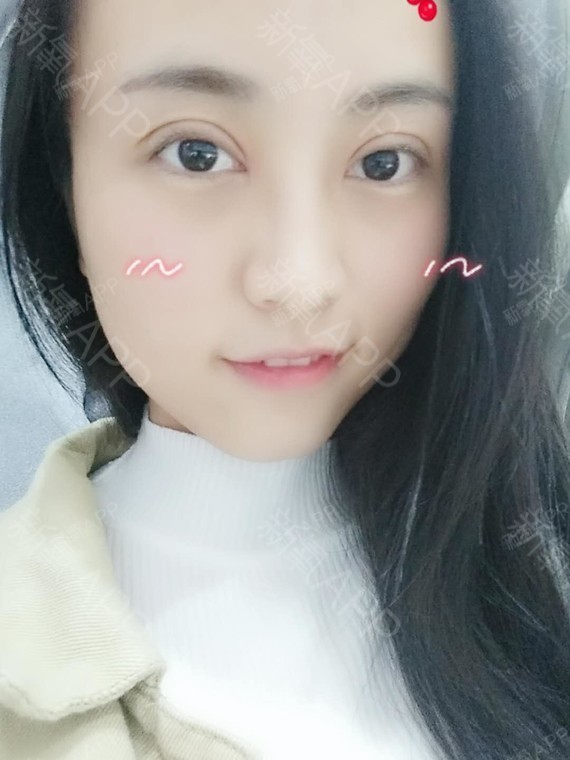 氧气x00q2切开双眼皮第10天美丽日记