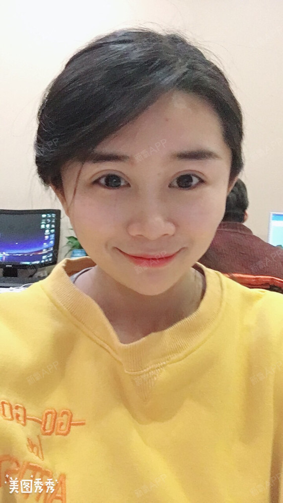 啦啦啦,一个月了,双眼皮也是恢复的比较自然了,自己_圈子-新氧美容