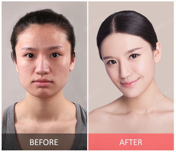 四川西婵整形美容医院玻尿酸全脸填充第0天美丽日记