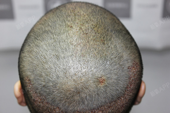 但是才三天小毛茬就有点长出来了,也真是神奇了  看来我的