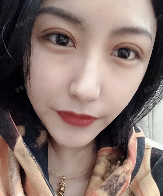 朋友说你的眼睛做完双眼皮_圈子-新氧美容整形