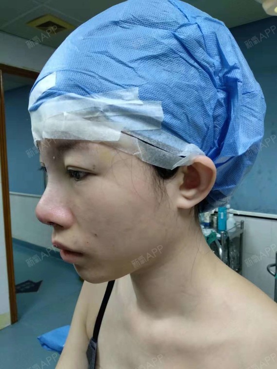 【民航广州医院 肋软骨隆鼻 第一天】