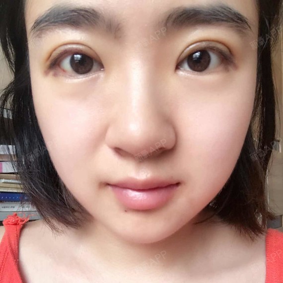 梓晓pan200303切开双眼皮第5天美丽日记