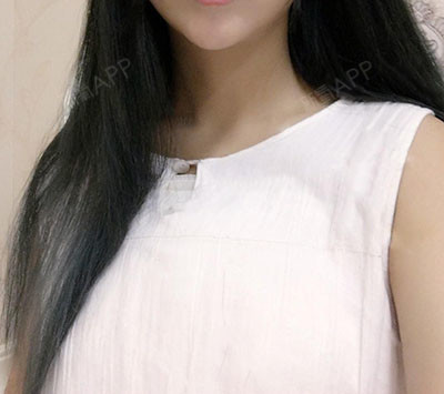 新氧- 氧气yue8c | 胸部 | 隆胸 | 假体隆胸 | 术后当自强 | 郑州同城