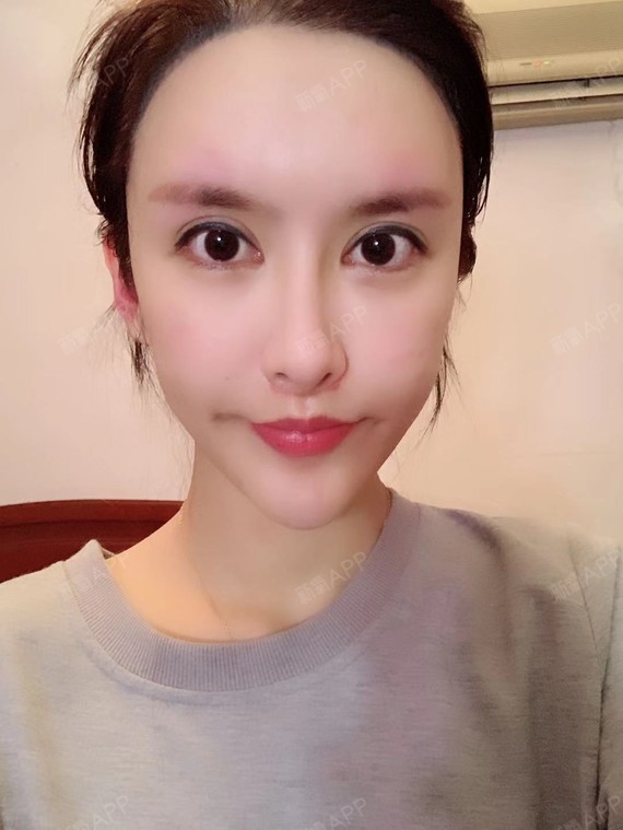 做的梨涡四十天,已经一个多月了,还是很自然的,半永_圈子-新氧美容