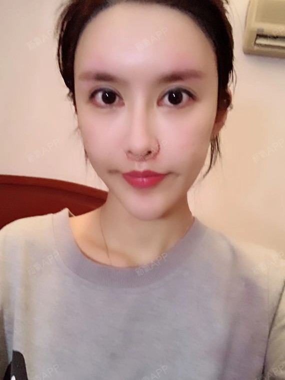 的梨涡四十天,已经一个多月了,还是很自然的,半永_圈子-新氧美容整形