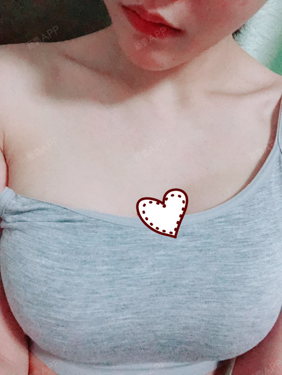 【武汉天后-假体隆胸-术后16天】假体隆胸手术半个_圈子-新氧美容整形