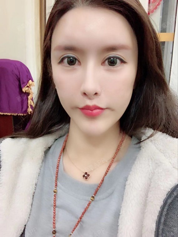 的梨涡四十天,已经一个多月了,还是很自然的,半永_圈子-新氧美容整形