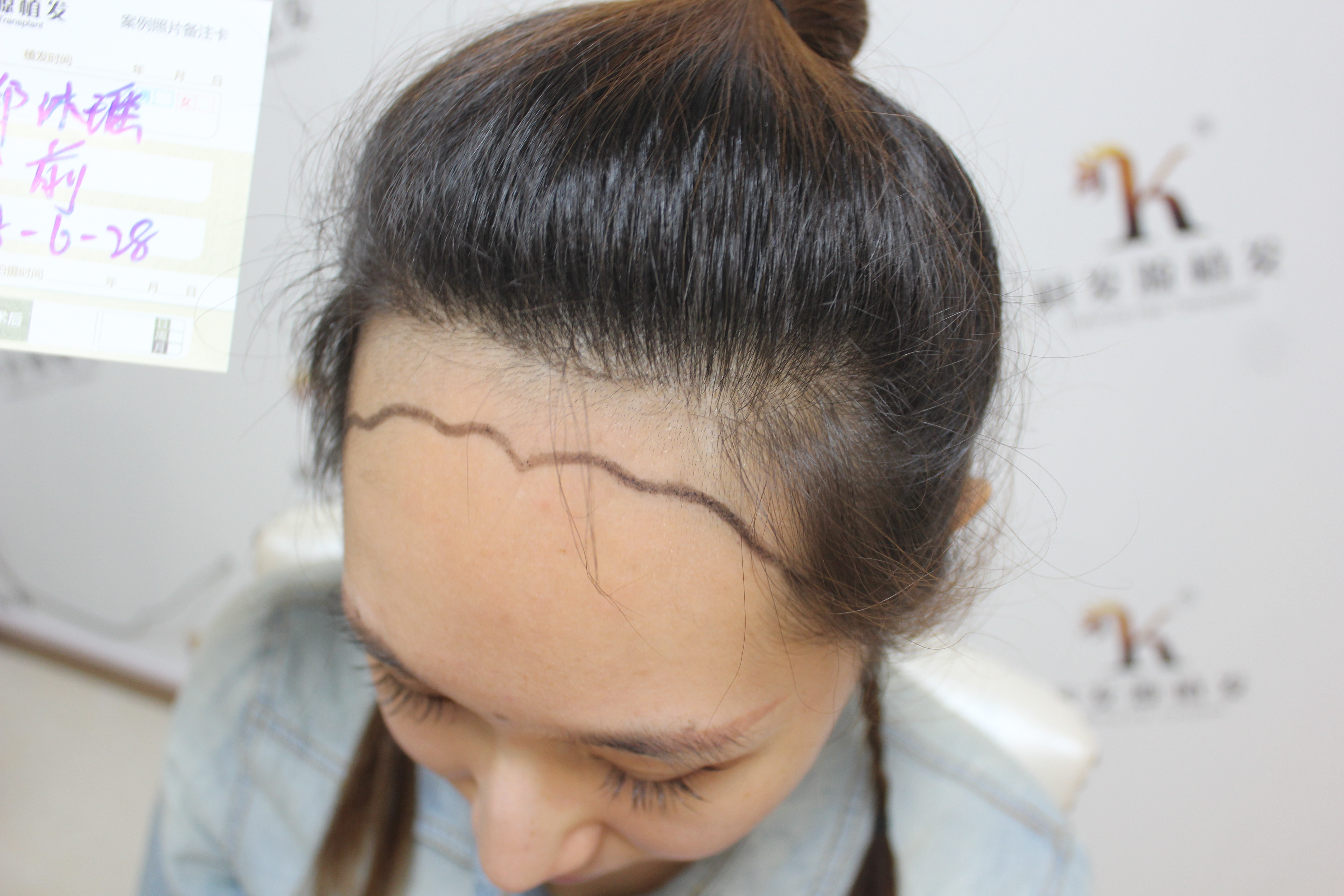 【女性植发】“发际线设计”是不能错过的核心过程之一 - 哔哩哔哩