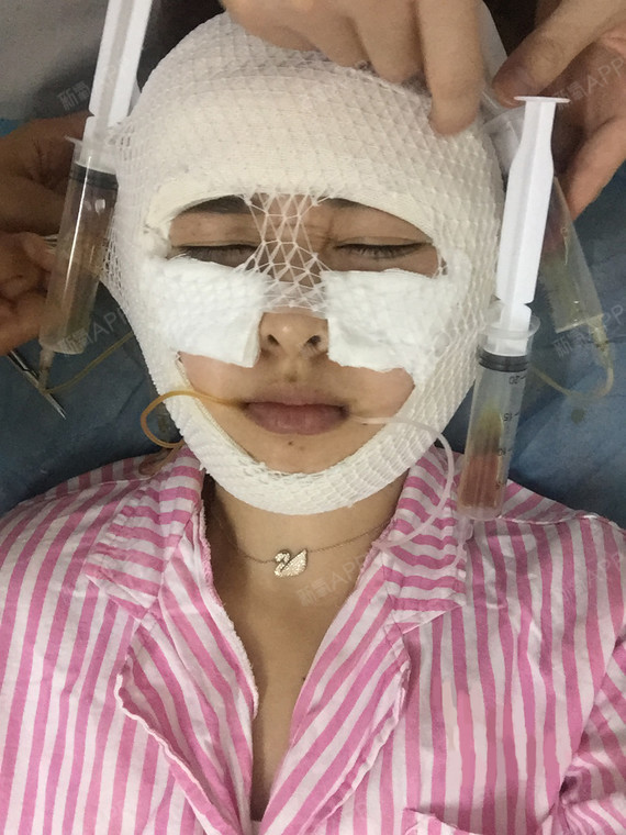 v-line瓜子脸手术