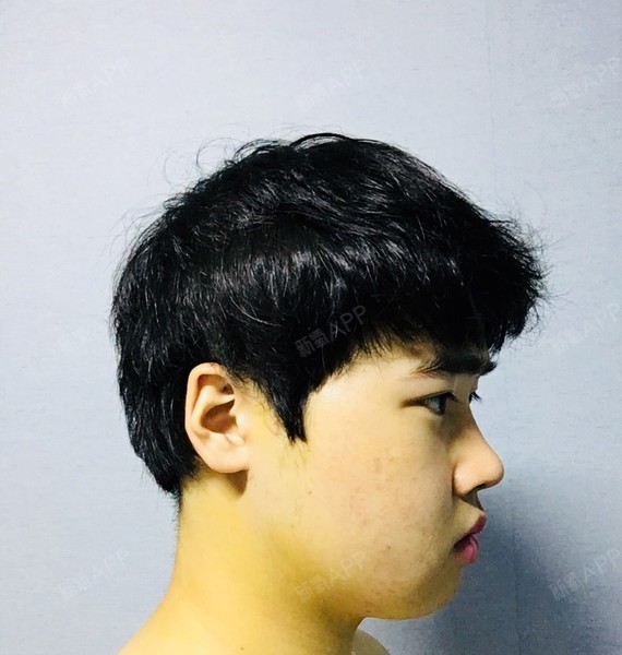 脸腮肿得一直不消,第一个月都是圆的,医生说我的脸型_圈子-新氧美容