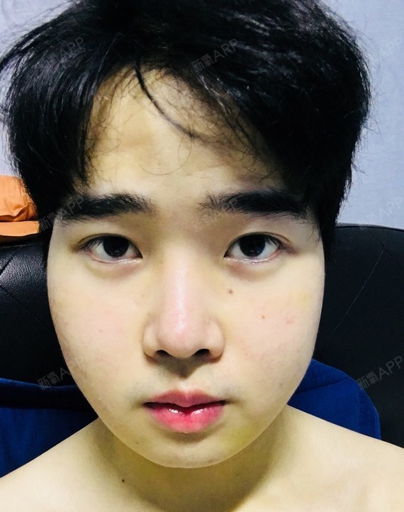 脸腮肿得一直不消,第一个月都是圆的,医生说我的脸型_圈子-新氧美容