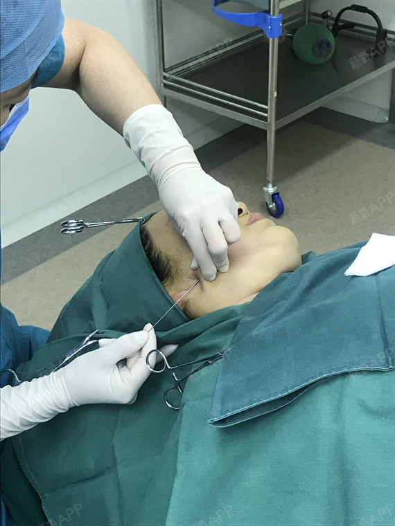 【北京炫美-线雕青春定格术-第0天】