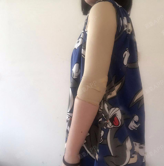 重庆吸脂瘦手臂好不好_效果图_fa679144吸脂瘦手臂术后第7天_新氧美容