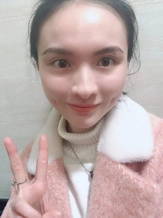 双侧埋线酒窝术后6天,两边消肿的不一样,看着有些不_圈子-新氧美容