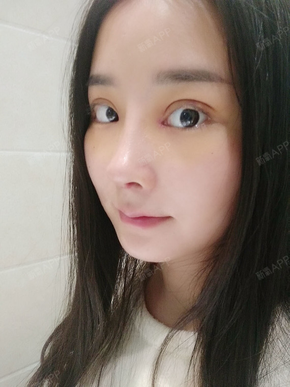 拆完线的那一刻感觉到特别的轻松_圈子-新氧美容整形