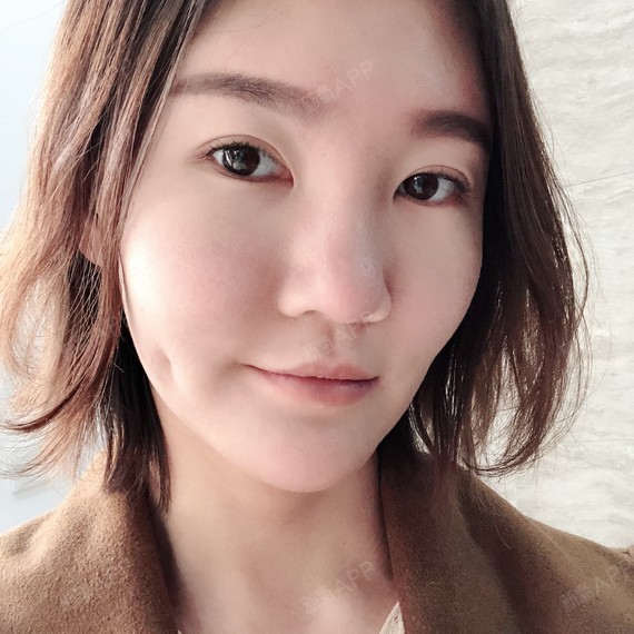 《翡立思唐为东医生单侧埋线酒窝》术后3天.