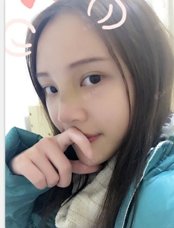 霸气小女森硅胶隆鼻第7天美丽日记