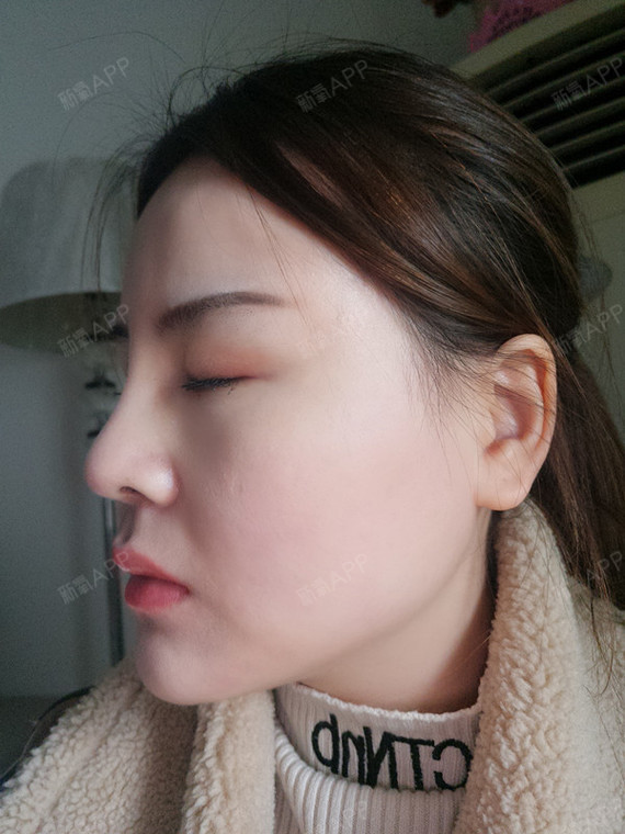 【长沙贝美鼻修复(玻尿酸) 假体隆鼻 耳软骨垫鼻尖