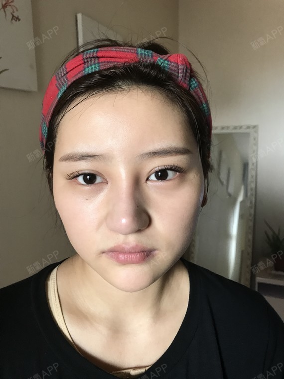 月悦开内眼角第2天美丽日记