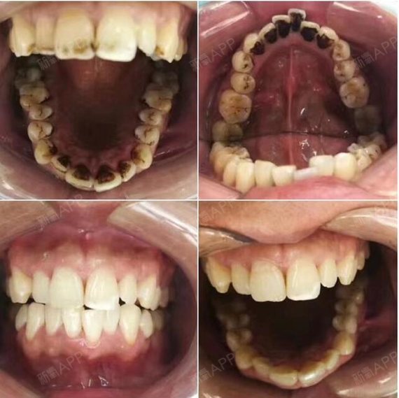 洗牙前和洗牙后的照片图片