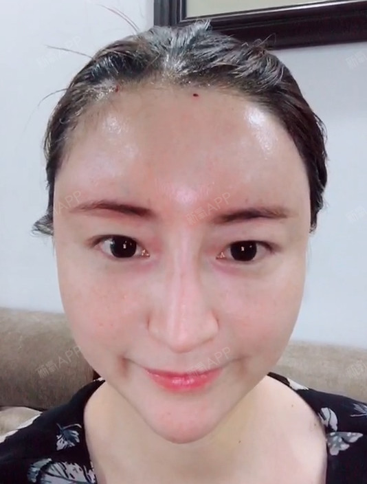 我一直对于我额头中间有条凹线不是很满意,这个呢!