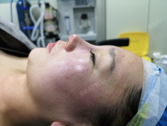 【北京亚楠容悦蒋亚楠院长假体隆鼻 自体筋膜隆鼻】我_圈子-新氧美容