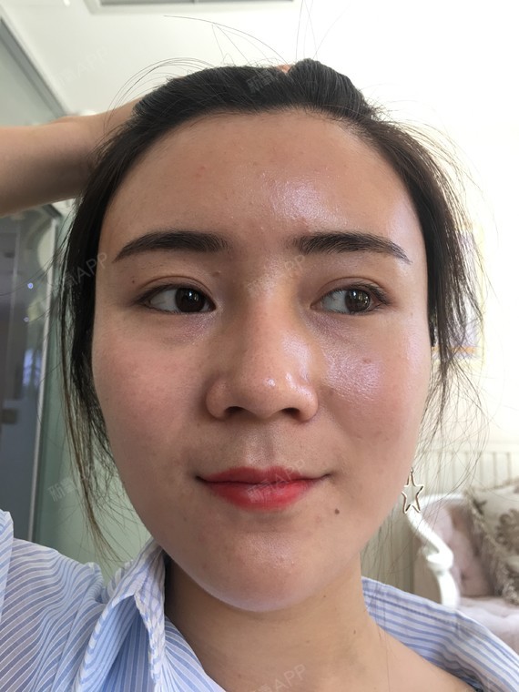 注射玻尿酸三个多月了,正面看着是有一些吸收的,鼻子_圈子-新氧美容
