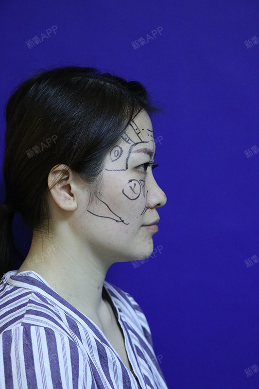 隆鼻手术一个月,鼻子恢复良好,现在是看不出丝毫痕迹了,很自然,好喜欢