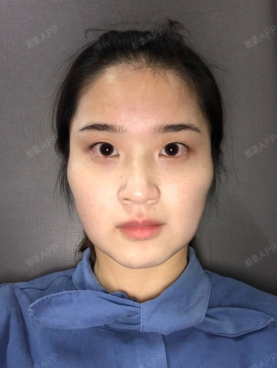 女人不光胸平不好,脸平也很容易显老啊!